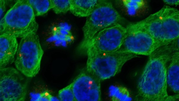 An image taken with a confocal microscope of a field of non-dividing and dividing human cancer cells is seen at The Institute of Cancer Research in London, in this handout photograph taken January 10, 2013. To match Insight CANCER-DRUGS/ REUTERS/The Institute of Cancer Research, London/Handout via Reuters (BRITAIN - Tags: HEALTH SCIENCE TECHNOLOGY) ATTENTION EDITORS – THIS IMAGE WAS PROVIDED BY A THIRD PARTY. NO SALES. NO ARCHIVES. FOR EDITORIAL USE ONLY. NOT FOR SALE FOR MARKETING OR ADVERTISING CAMPAIGNS. THIS PICTURE IS DISTRIBUTED EXACTLY AS RECEIVED BY REUTERS, AS A SERVICE TO CLIENTS