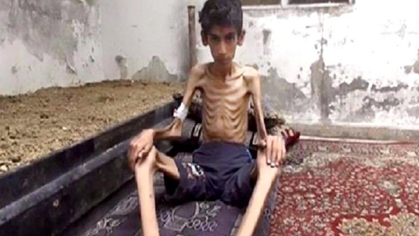 This undated photo posted on the Local Revolutionary Council in Madaya, which has been verified and is consistent with other AP reporting, shows a starving boy in Madaya, Syria. The Syrian government has agreed to allow humanitarian assistance into three beleaguered villages following reports of malnutrition in the area, a U.N. official said Thursday.Two of the villages in question are the adjacent Shiite villages of Foua and Kfarya in the country s north, which have been besieged by anti-government militants for more than a year. The third is the village of Madaya near the border with Lebanon, which has been under siege by government forces since early July. (Local Revolutionary Council in Madaya via AP)